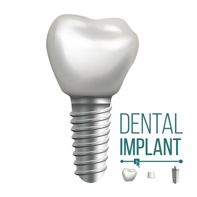 Dental Implants