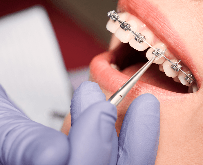 Root Canal Treatment