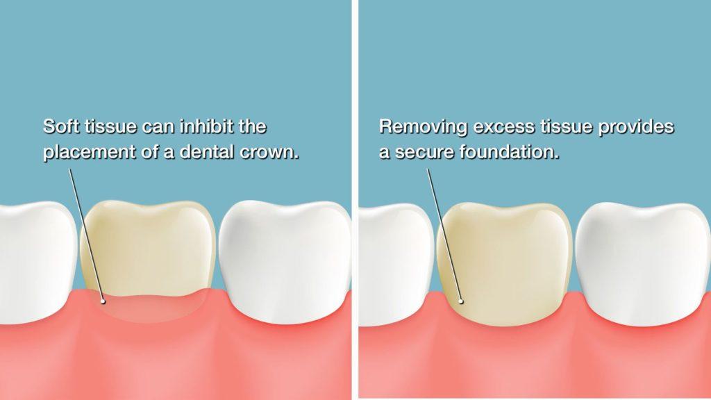 Dental Crowns