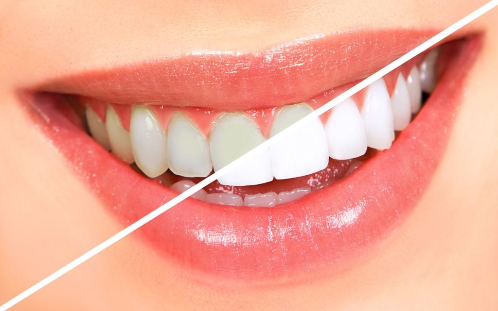 Teeth Whitening (Bleaching)