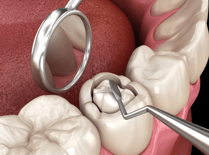 Dental Fillings